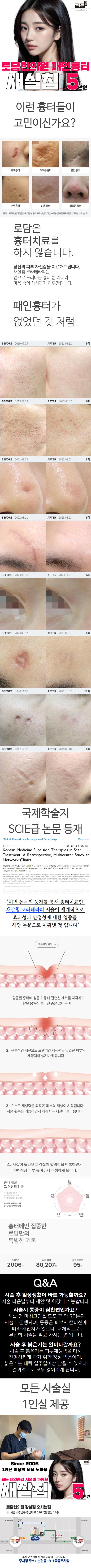 2006년에 로담한의원에서 개발된 새살침 코라테라피 시술은 여드름흉터, 성형흉터, 수술흉터, 수두흉터 등 모든 패인흉터 시술이 가능한 시술입니다.
새살침 시술은 근본적으로 패인부분을 채워올리는것이 시술이며, 시술 후 다시 꺼질염려가 없는 시술입니다.
시술 다음날부터 세안 및 화장이 가능하며, 1인실이 제공되므로 편안하게 시술받으실 수 있으십니다.