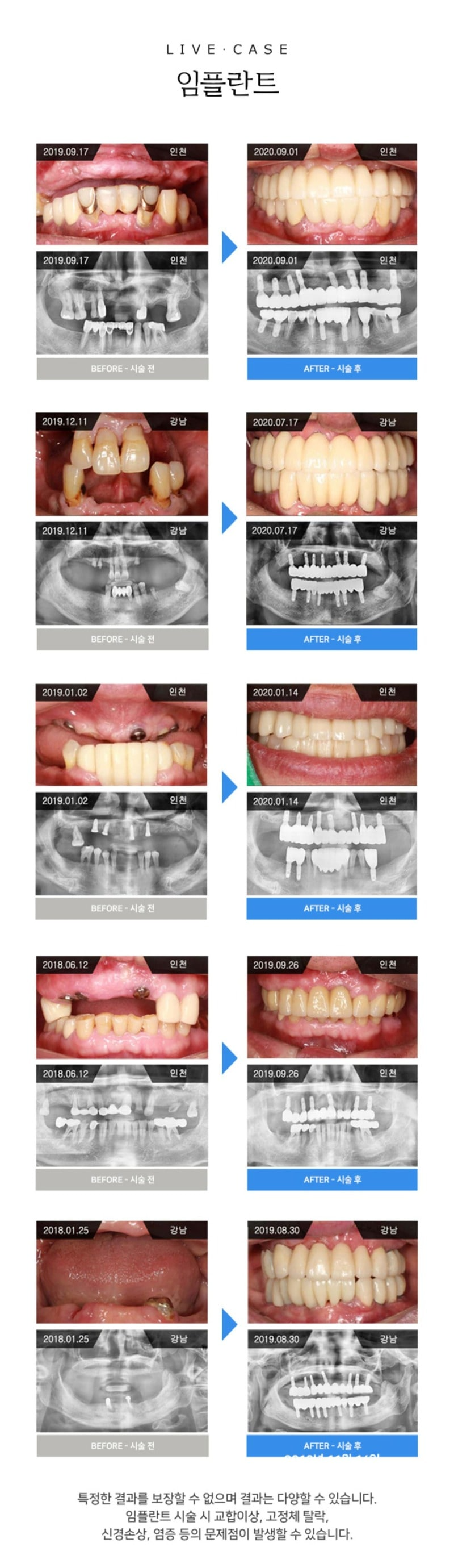 30세 이상 임플란트 시술을 원하는 강남언니 회원 대상!
지르코니아 크라운이 포함된 오스템 임플란트 39만원
- 10년 관리 프로그램 보유로 평생 사용할 임플란트 관리까지 철저하게!
- 실제 환자들의 만족후기로 믿을 수 있어요!
- 10년 넘게 자리를 지킨 폐업 우려 없는 '병원급' 치과!
- 하루만에 임플란트 가능한 원데이 임플란트!
- 자체 기공소 보유로 맞춤형 지대주 사용!