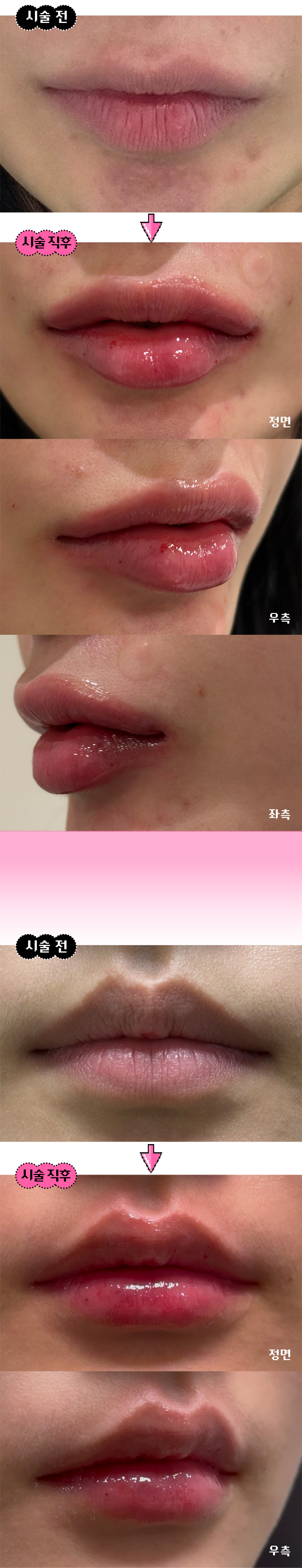 시술 전) 대표원장님과 1:1 맞춤 디자인 상담
시술 중) 고객님과 시술 중간마다 꼼꼼하게 디자인 체크
시술 후) 안심콜로 책임감 있는 고객케어
2025 전국 51인 Allergan AMI Global Fatculty '이경환' 대표원장님의 독자적 Project Codes 시술법으로, 나만의 분위기에 어울리는 입술을 찾아드리겠습니다.