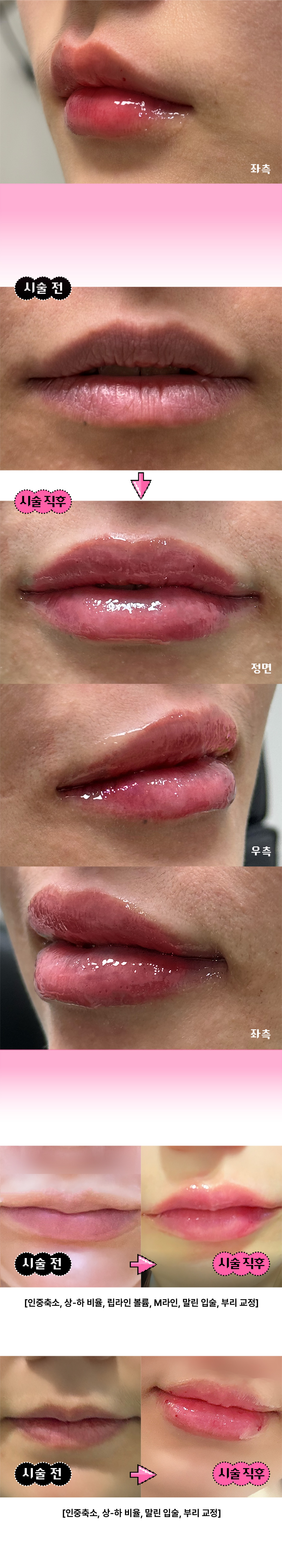 시술 전) 대표원장님과 1:1 맞춤 디자인 상담
시술 중) 고객님과 시술 중간마다 꼼꼼하게 디자인 체크
시술 후) 안심콜로 책임감 있는 고객케어
2025 전국 51인 Allergan AMI Global Fatculty '이경환' 대표원장님의 독자적 Project Codes 시술법으로, 나만의 분위기에 어울리는 입술을 찾아드리겠습니다.