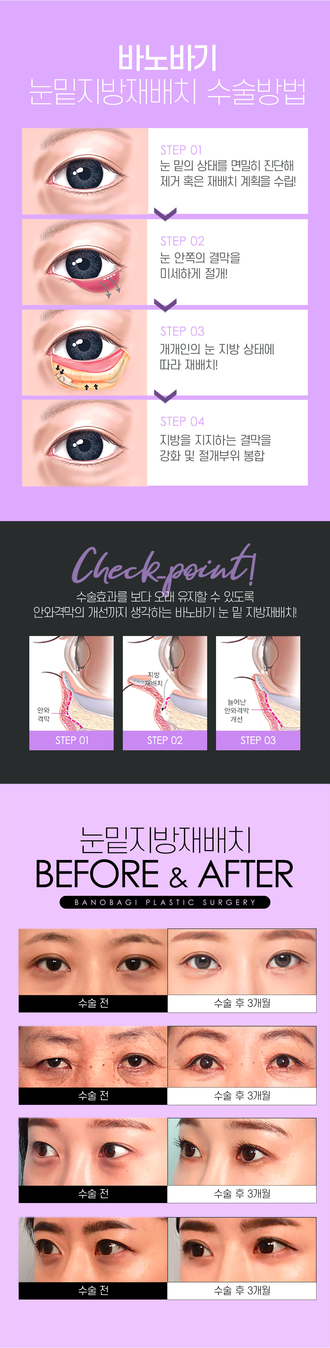 눈밑 고민을 개선하는 바노바기 눈밑지방재배치