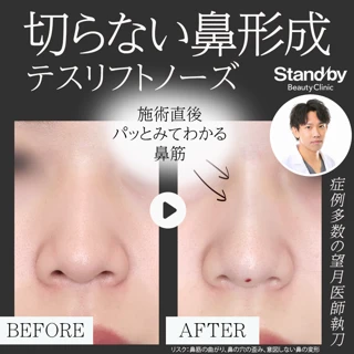 切らない鼻整形：テスリフトノーズ ND,NC