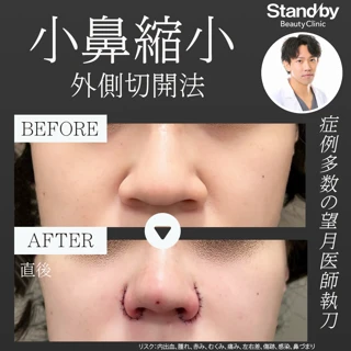 小鼻縮小外側切開法