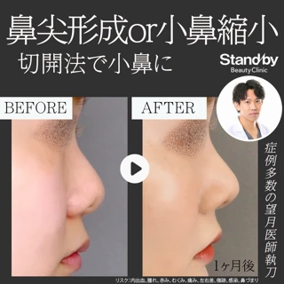 鼻尖形成切開法 or 小鼻縮小内側切開法