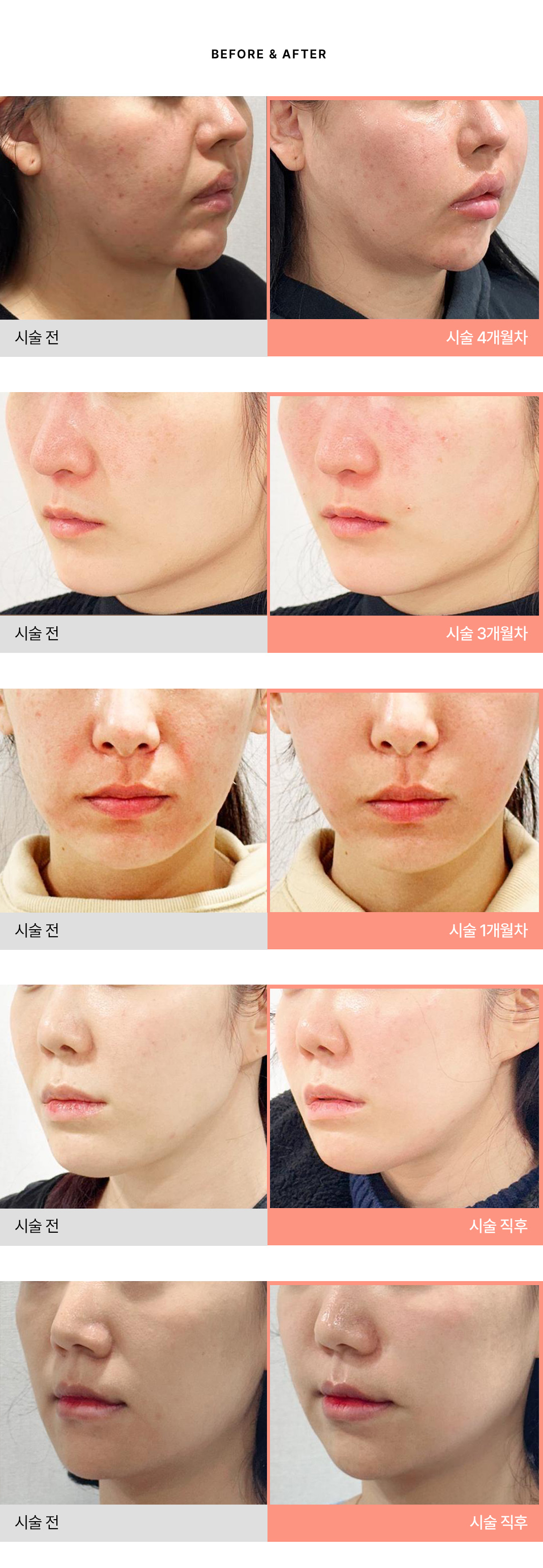 1. 피부탄력 모공 잔주름 케어
2. 시술 전 마크뷰 피부 진단기기를 통해 피부타입을 진단 후 시술 진행
3. 통증에 예민하다면 오셔서 진료 후 수면마취 가능
울쎼라피 프라임 ADM
쥬베룩 키닥터 병원
덴서티 키닥터 병원
포텐자 키닥터 병원
벨로테로필러 자문의
에피티크 바디필러 키닥터 병원
레스틸렌필러, 스컬트라 키닥터 병원
올리디아 키닥터 병원
울쎄라 자문의 병원