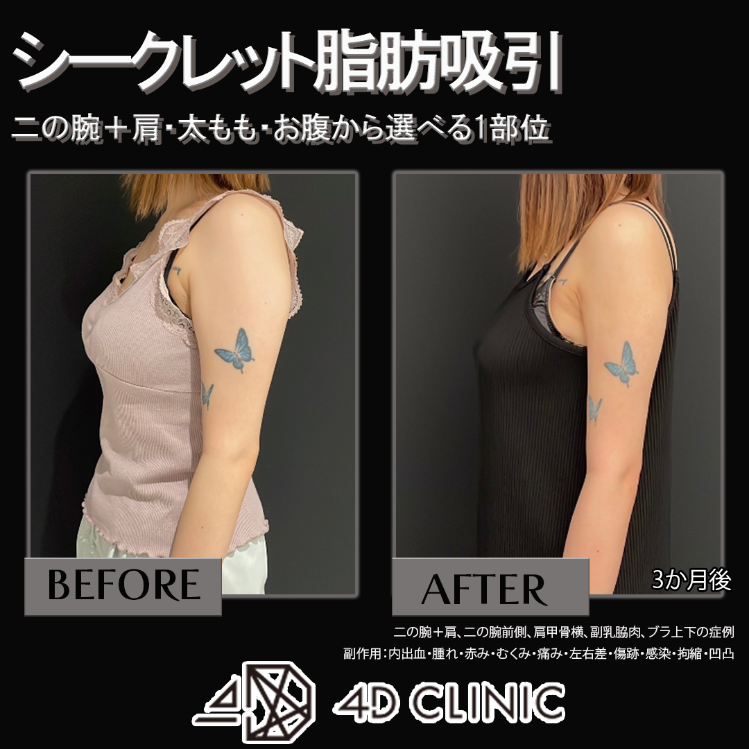 脂肪冷却の吸引カップ　アタッチメント No.2 渋谷 二の腕脂肪吸入注射 おすすめクリニック・値段の比較(2025