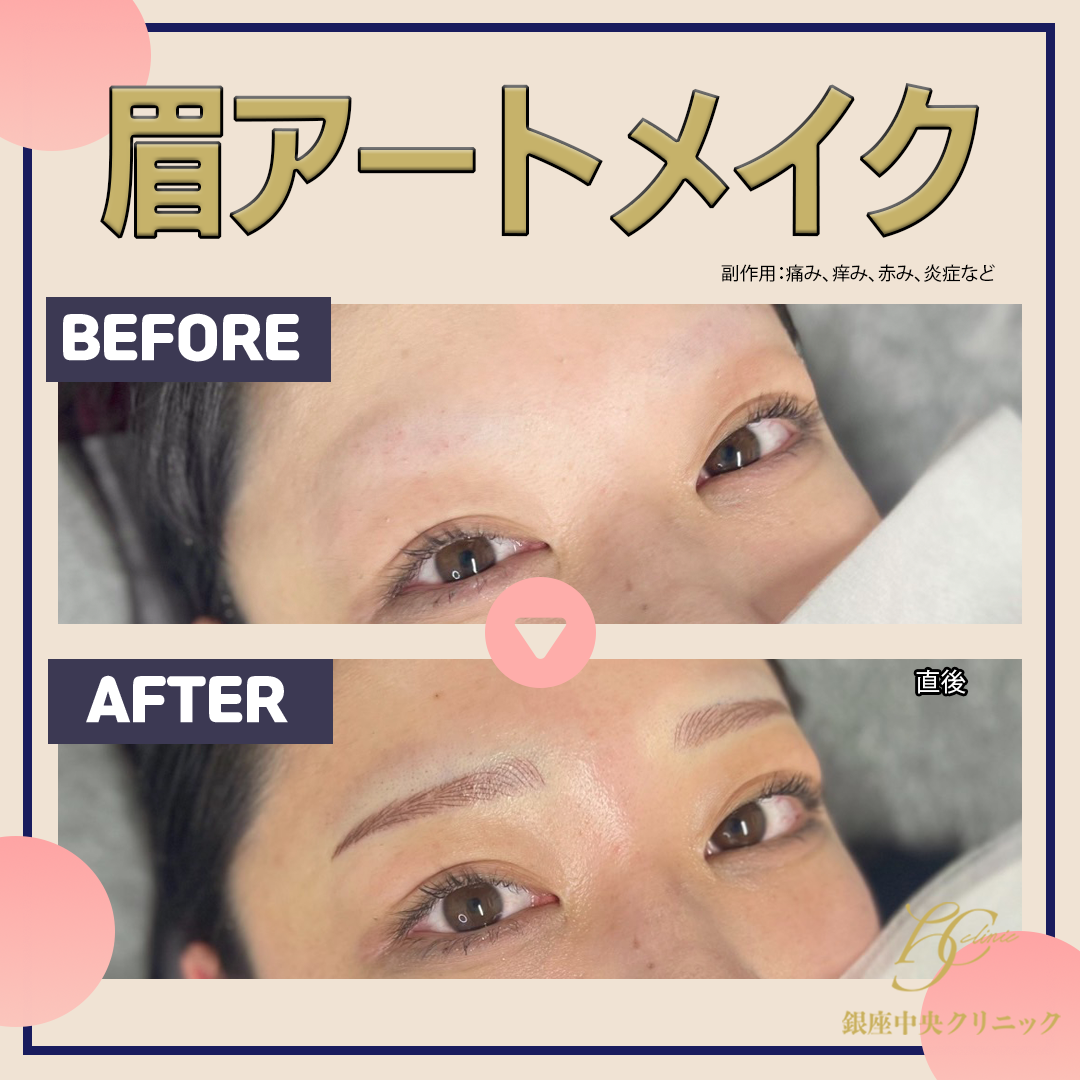 1回】眉毛アートメイク（MIX、毛並み、パウダー） | 銀座中央クリニック