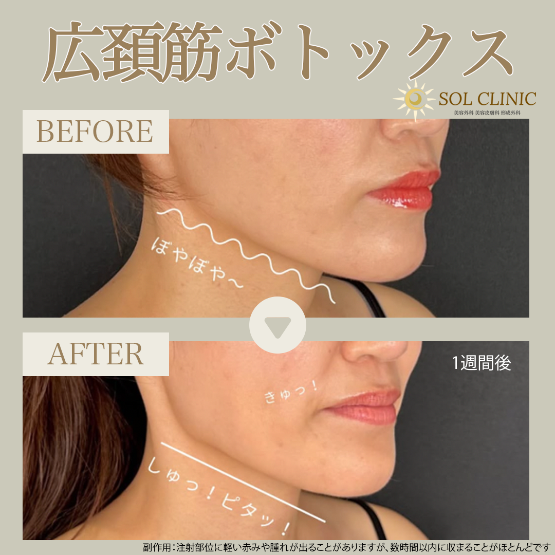️広頚筋ボトックス｜アラガン製20単位 | SOL CLINIC
