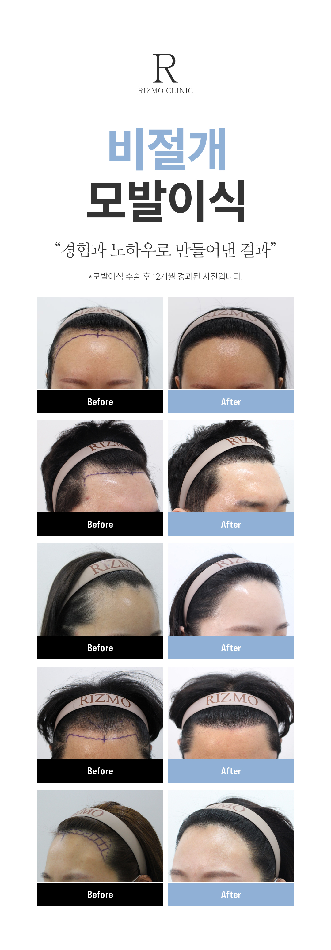 리즈모의 모든 모발이식 과정은 숙련된 의사가 직접 집도합니다. 모낭 채취부터 슬릿(모낭을 이식할 미세 절개), 그리고 이식에 이르기까지 모든 단계에서 의사의 섬세한 손길이 닿아 높은 생착률과 자연스러운 결과를 선사합니다.
리즈모는 **10년 이상 '비절개 모발이식'**이라는 한 분야에만 집중해 왔습니다. 오랜 연구와 수많은 수술 경험을 통해 비절개 모발이식에 대한 독보적인 기술력을 갖추게 되었습니다.
하지만 리즈모는 무조건적인 수술을 권하지 않습니다. 탈모 초기에는 약물 치료가 우선되어야 한다는 것을 잘 알고 있기 때문입니다.
그러나 약물 치료만으로는 한계가 있는 경우, 모발이식이 잃어버린 자신감을 되찾을 수 있는 유일한 희망이 될 수 있습니다. 리즈모는 이러한 분들에게 최고의 결과를 선사하기 위해 진심을 다해 수술에 임하고 있습니다.