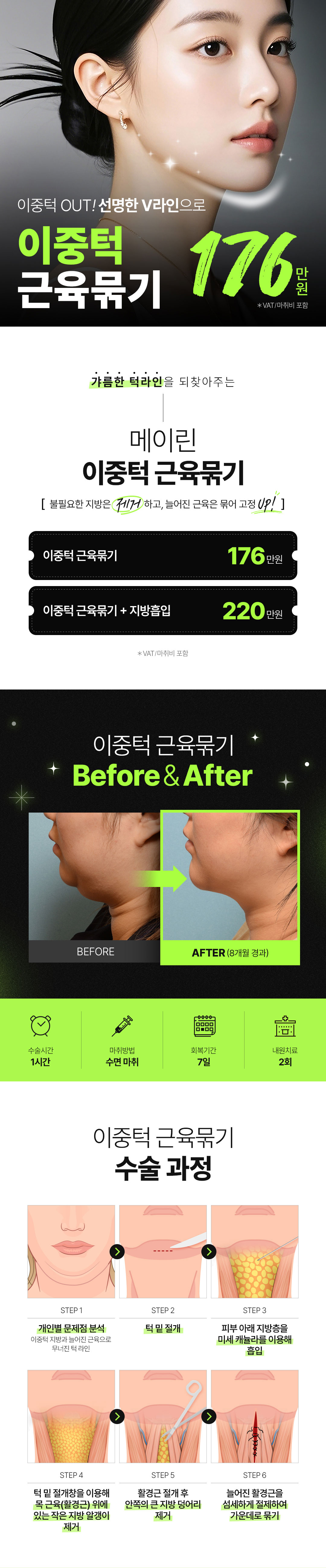 처진 턱밑 살과 이중턱을 개선하기 위해 목 부위의 근육을 묶어 올려주는 수술입니다.