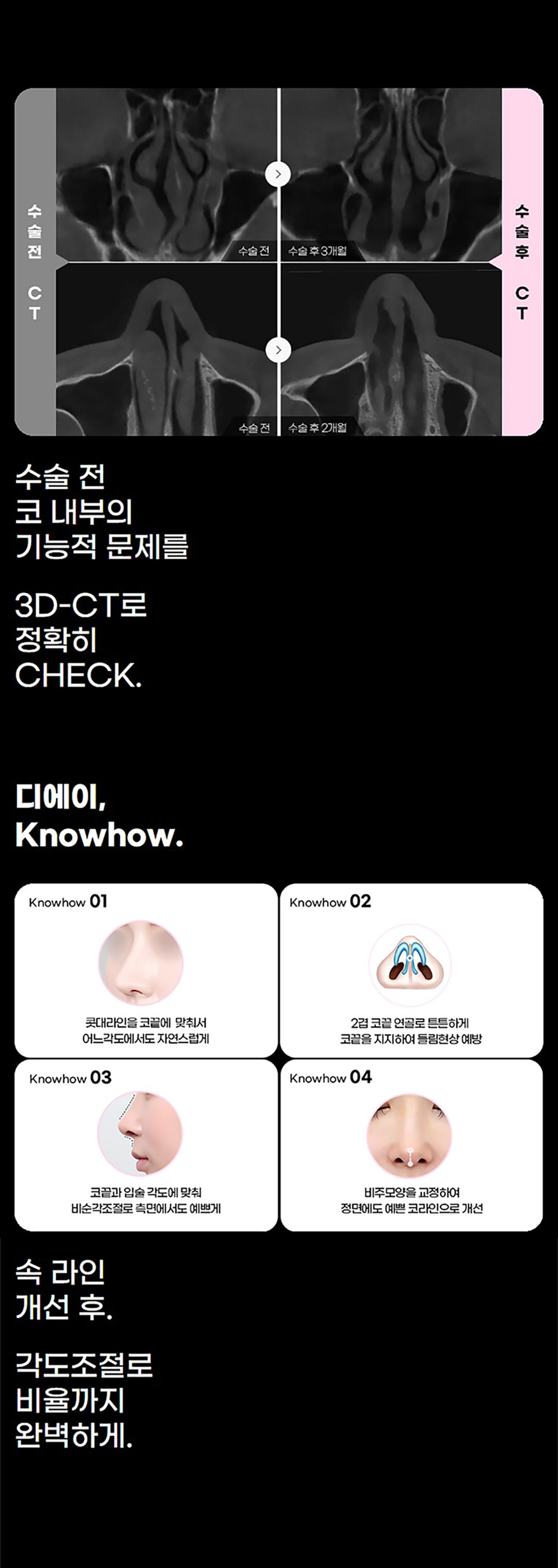 코끝부터 콧대까지 개선하는 비염코성형