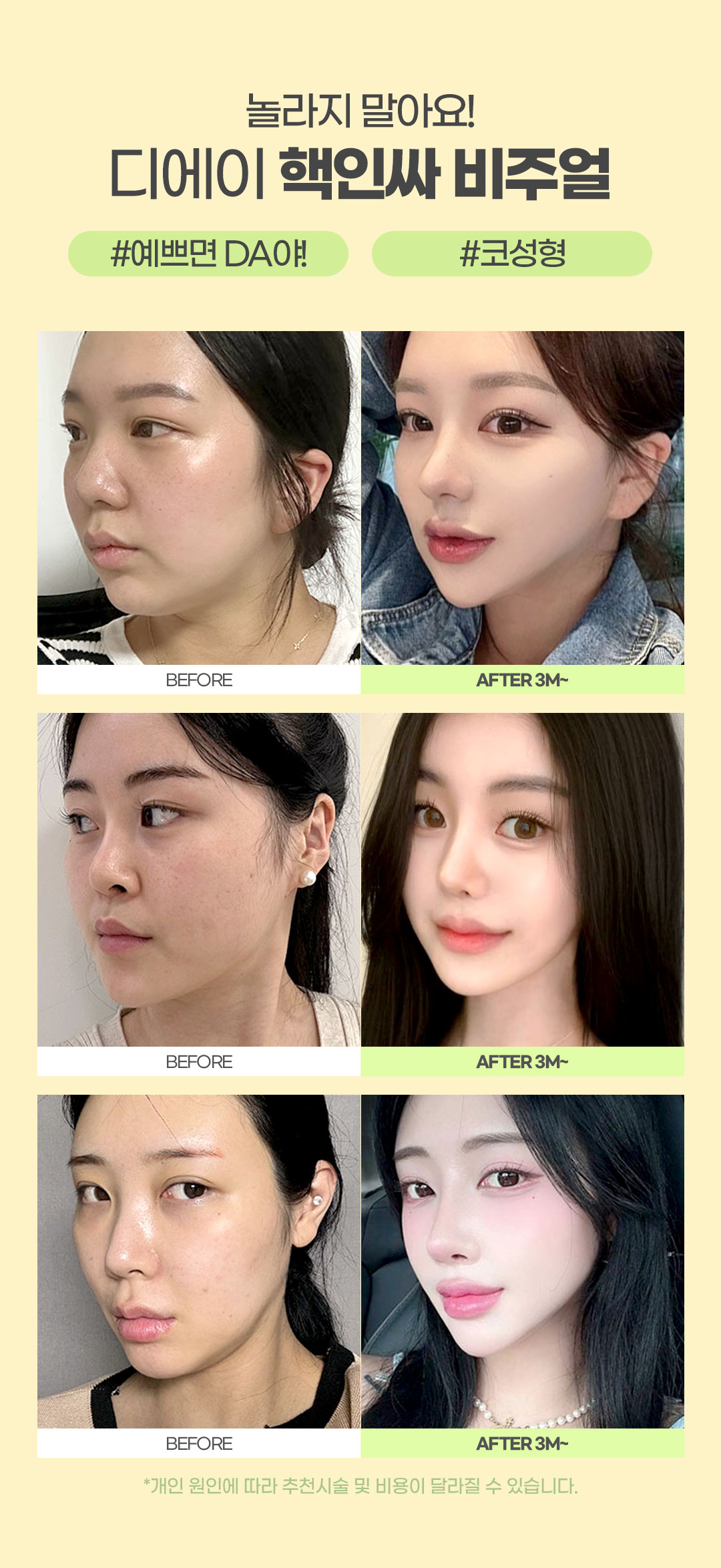 코끝부터 콧대까지 개선하는 비염코성형