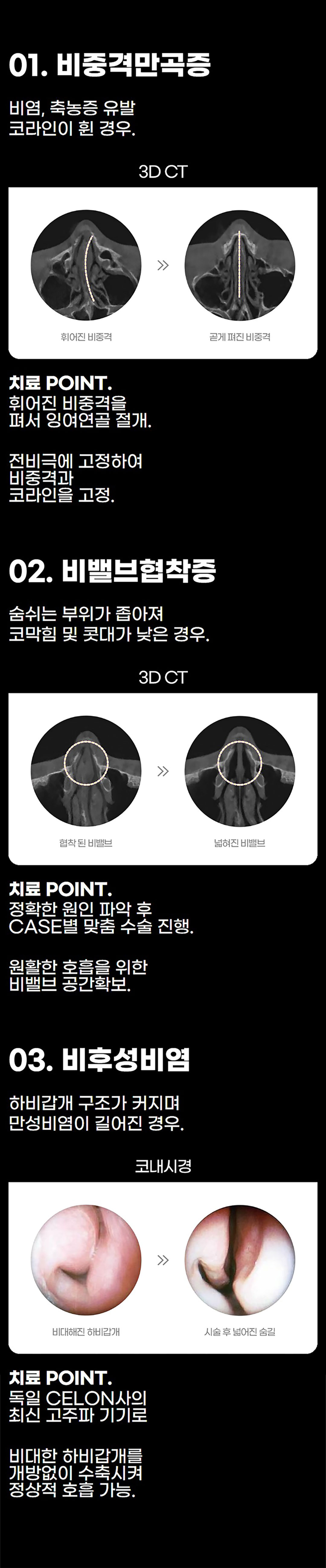 코끝부터 콧대까지 개선하는 비염코성형