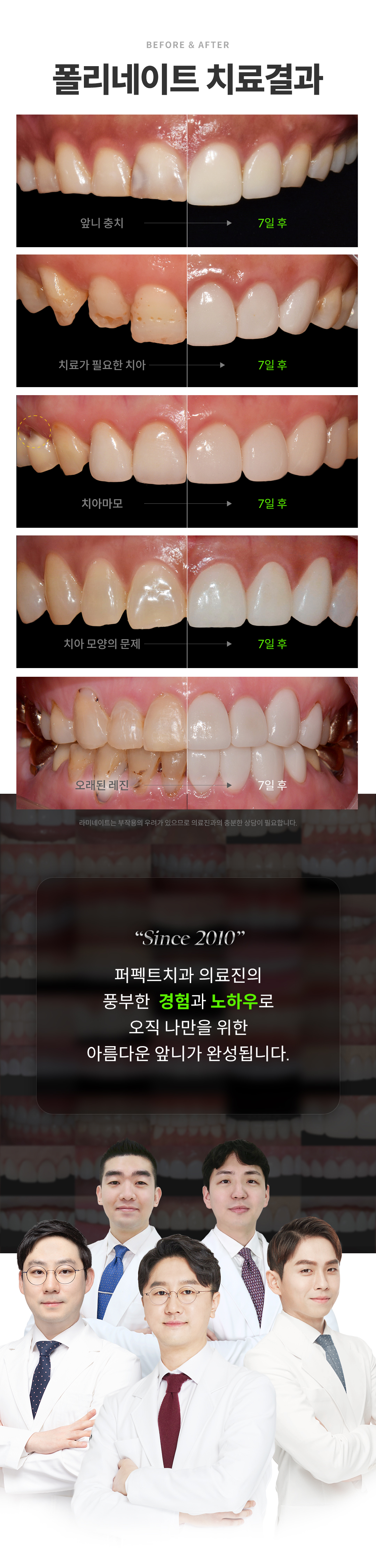 무삭제 라미네이트의 한계를 뛰어넘다.
나만을 위한 폴리네이트