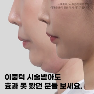대구 얼굴지방흡입, 이중턱지방흡입, 턱선리프팅