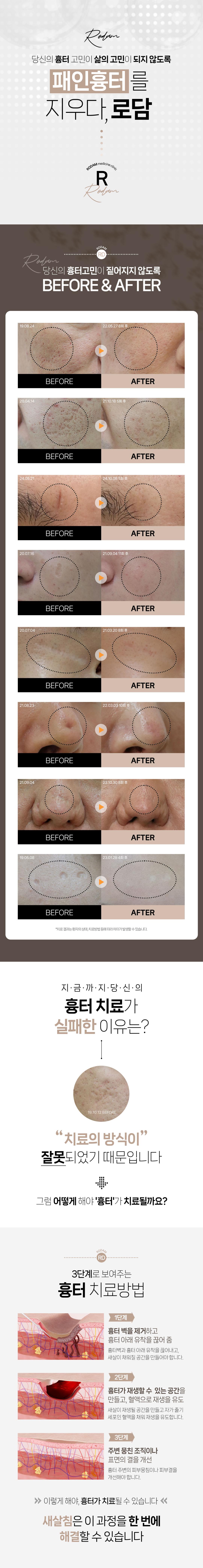 얼굴 패인 흉터를 깎지 않고도 치료할 수 있습니다. 
피부 속부터 새살이 차오르게 하는 새살침을 지금 체험해보세요.
SINCE 2006 새살침 코라테라피가 시작된 곳, 로담한의원입니다. 