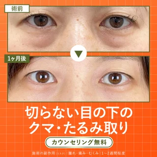 切らないクマ取り|局所麻酔込み(経結膜脱脂法)