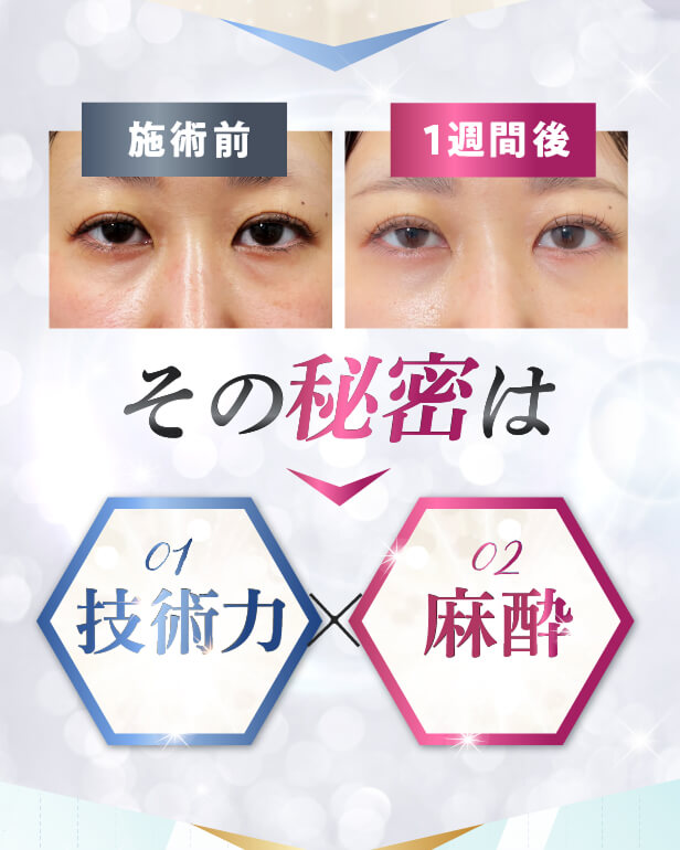 【利用条件・モニターについて】
・SNSやHP等に全顔の掲載が可能な方
・施術前後に一定回数クリニックに通院し、ビフォー/アフターの撮影が可能な方
※非モニターの場合、通常価格でのご案内となります。
【当日施術について】
当日の施術室の空き枠次第でご案内可能です。
【アフターケアについて】
ダウンタイムの過ごし方や注意事項などの詳細は、カウンセリング時にしっかりとお伝えさせていただきます。
当院は、術後のアフターケアに力を入れております。
ダウンタイム中に感じた不安点やトラブルなどは、すぐに対応いたします。
安心して受診・施術できるようスタッフが一丸となってサポートさせていただきますのでお気軽にご相談下さいませ。