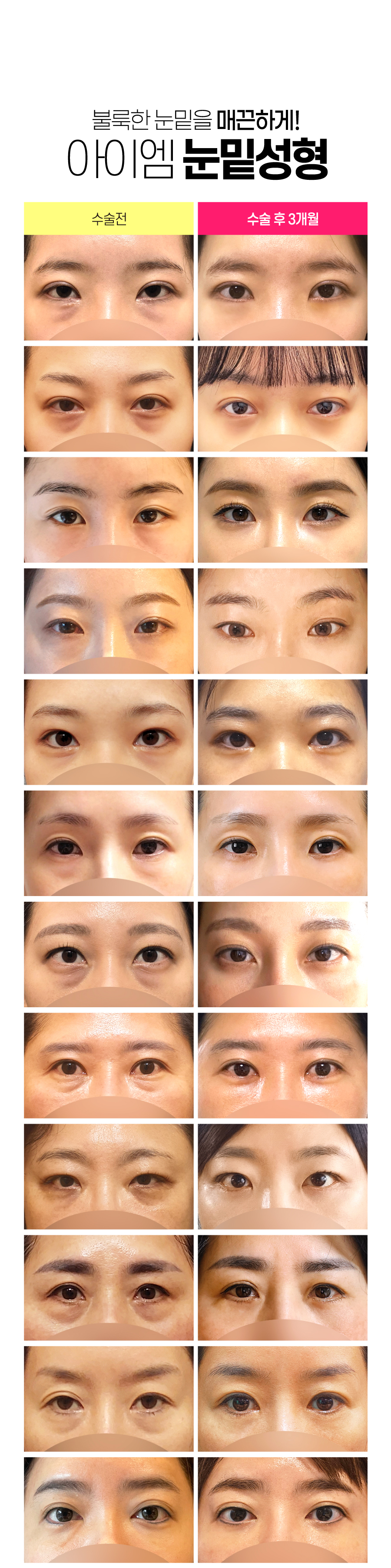 불룩한 눈밑지방과  다크써클 개선,  눈밑꺼짐을 개인과 연령대에 맞게 눈밑지방재배치 또는 중년하안검 수술을 통해 눈밑을 환하게 밝히다