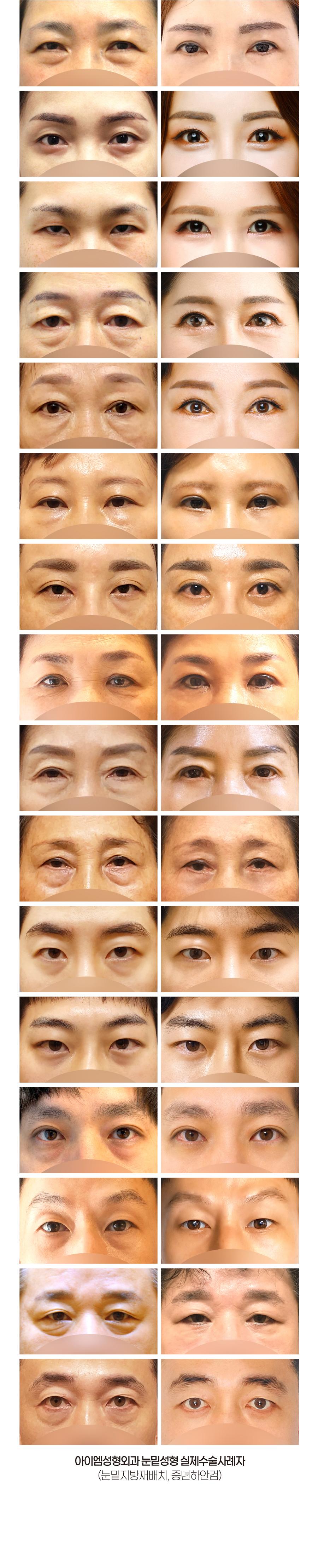 불룩한 눈밑지방과  다크써클 개선,  눈밑꺼짐을 개인과 연령대에 맞게 눈밑지방재배치 또는 중년하안검 수술을 통해 눈밑을 환하게 밝히다