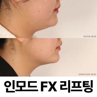 인천 이중턱 해결 인모드fx 리프팅