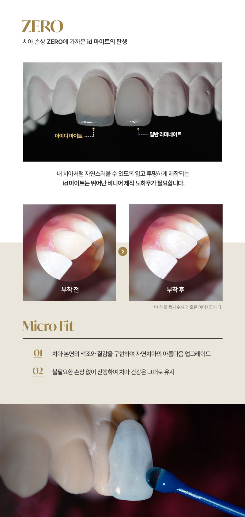 누런이, 토끼이, 벌어진 치아
걱정은 이제 그만! 
아이디 마이트 솔루션으로 
튼튼하고 자연스러운 라미네이트를 경험해보세요! 

독보적인 기술력으로 렌즈보다 
얇은 두께로 불필요한 치아 손상 없이 
아름다운 미소를 완성 할 수 있습니다. 