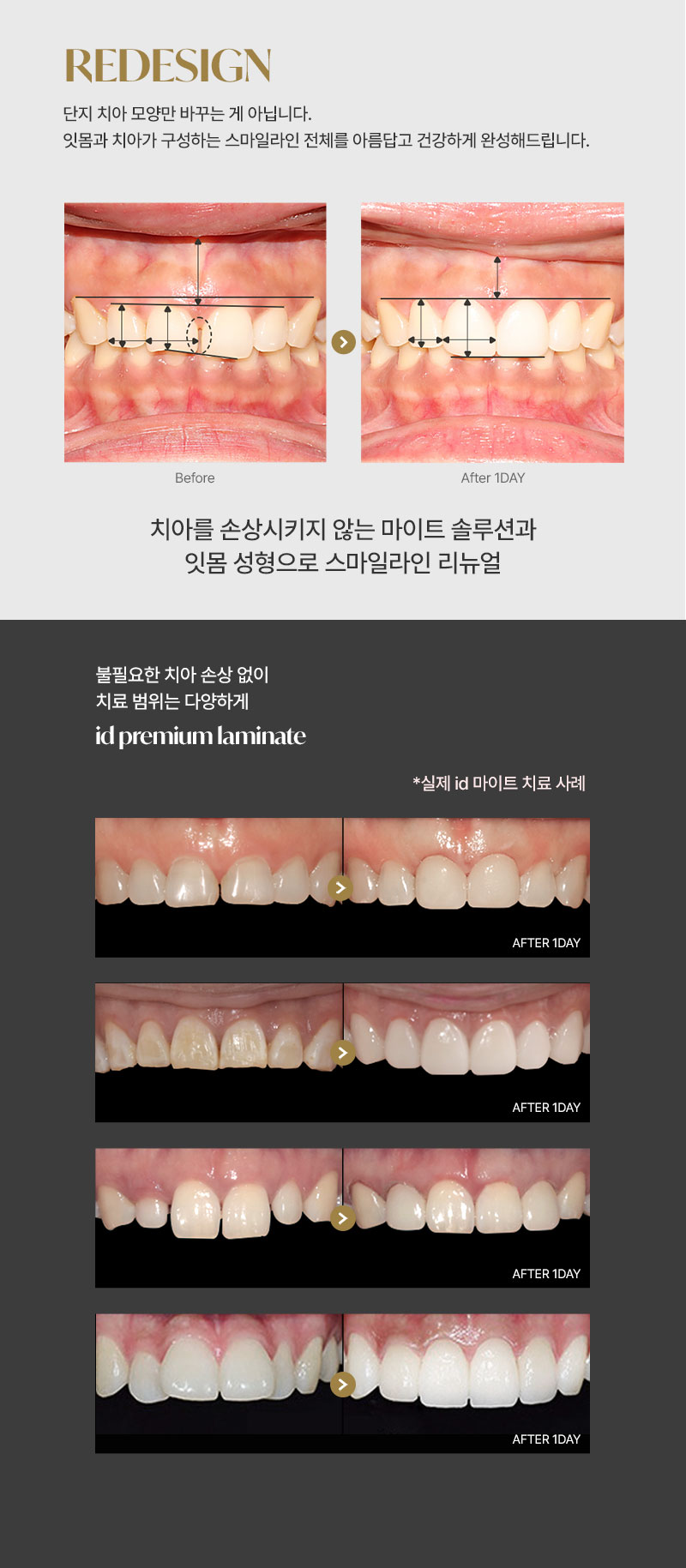 누런이, 토끼이, 벌어진 치아
걱정은 이제 그만! 
아이디 마이트 솔루션으로 
튼튼하고 자연스러운 라미네이트를 경험해보세요! 

독보적인 기술력으로 렌즈보다 
얇은 두께로 불필요한 치아 손상 없이 
아름다운 미소를 완성 할 수 있습니다. 