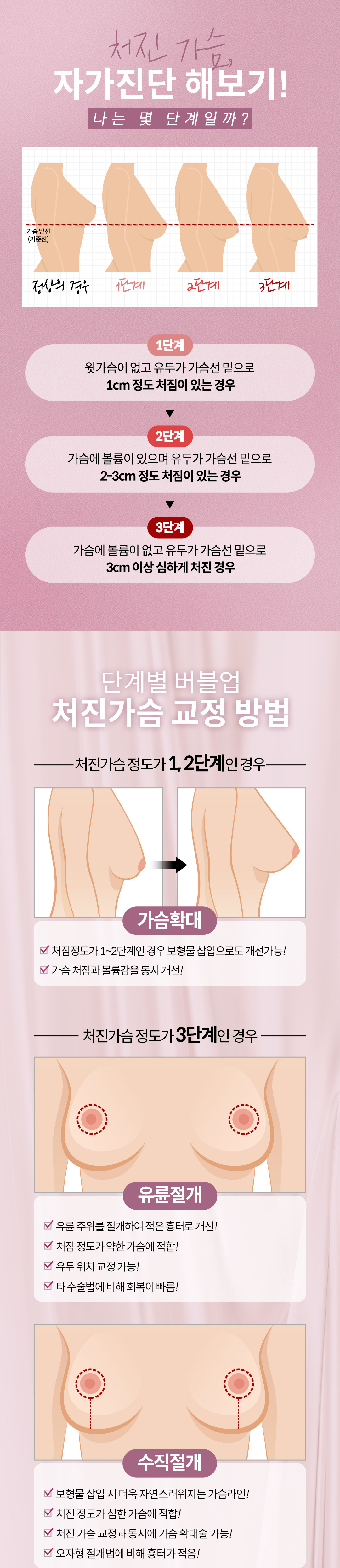 모유수유, 다이어트 등으로 처진 가슴도 역시 바노바기 디테일 가슴성형 