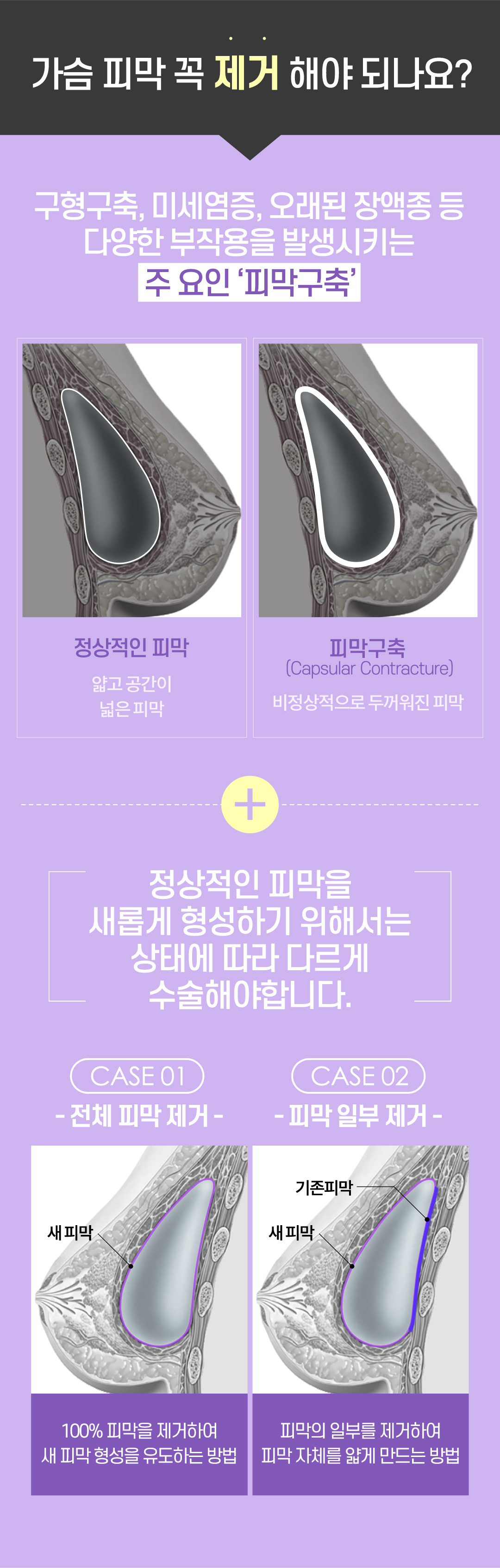 바노바기의 까다로운 선택, 안전하고 아름답게 멘토 엑스트라 가슴 재수술