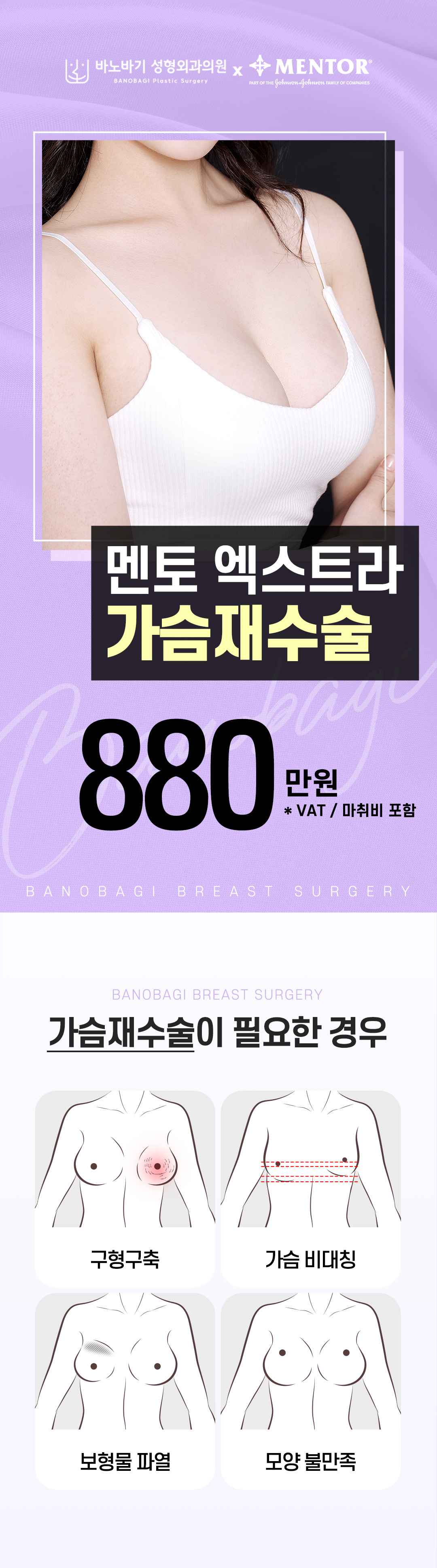 바노바기의 까다로운 선택, 안전하고 아름답게 멘토 엑스트라 가슴 재수술