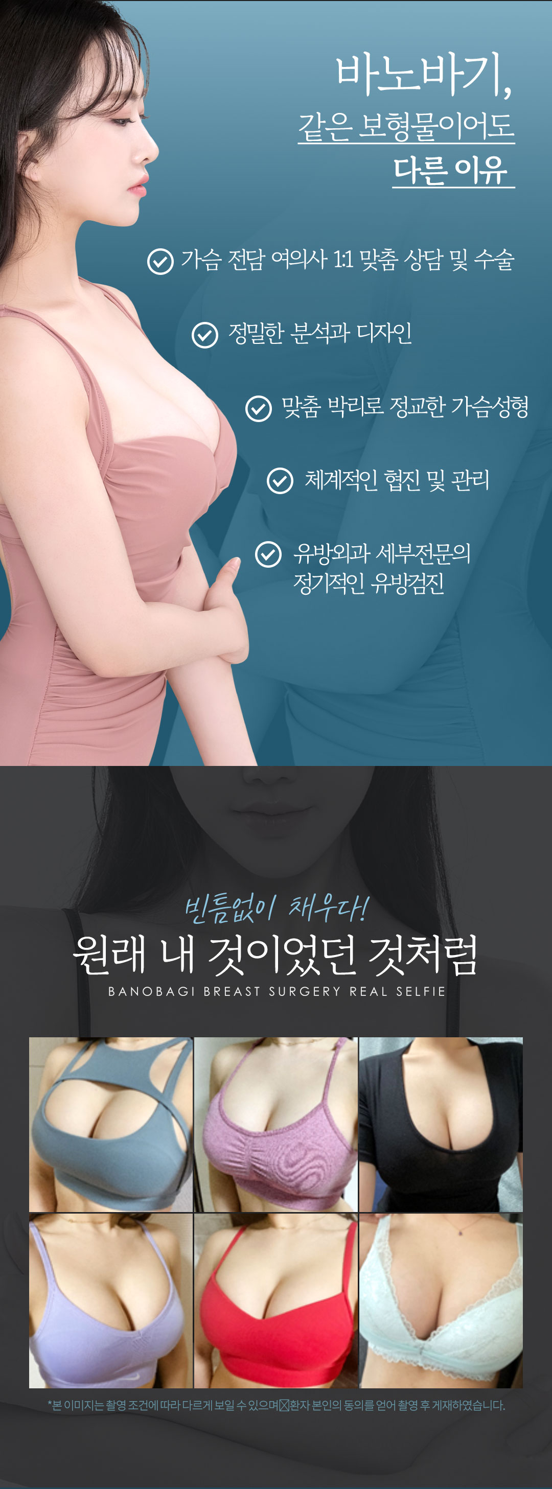 가슴수술은 안전하고 아름답게, 바노바기의 안전을 위한 까다로운 선택, 멘토 엑스트라 가슴성형