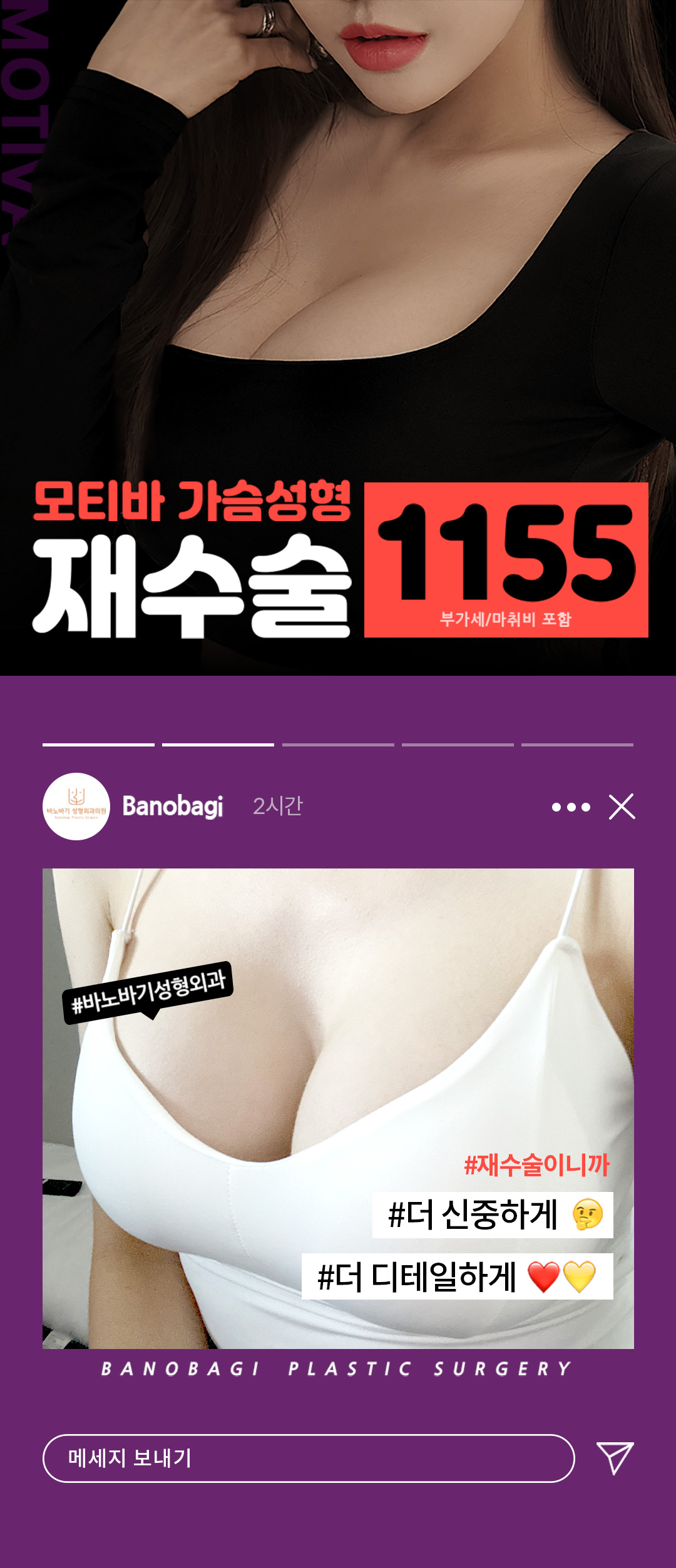 재수술이니까 더 신중하게 더 디테일하게, 바노바기 모티바 가슴 재수술