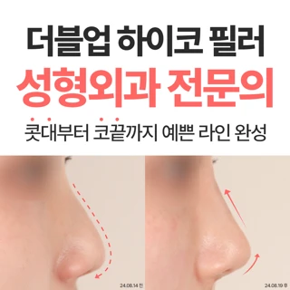 더블업 하이코 필러 성형외과 전문의