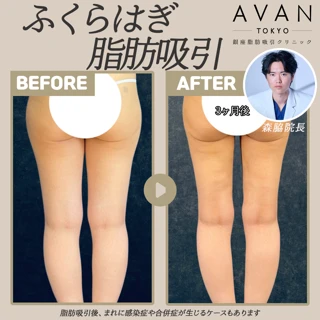 ふくらはぎ脂肪吸引|華奢な脚に|症例1,300件以上の森脇院長施術