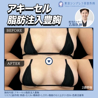 アキーセル脂肪注入豊胸|採取代込み|バストアップ・体痩せ同時に叶う!
