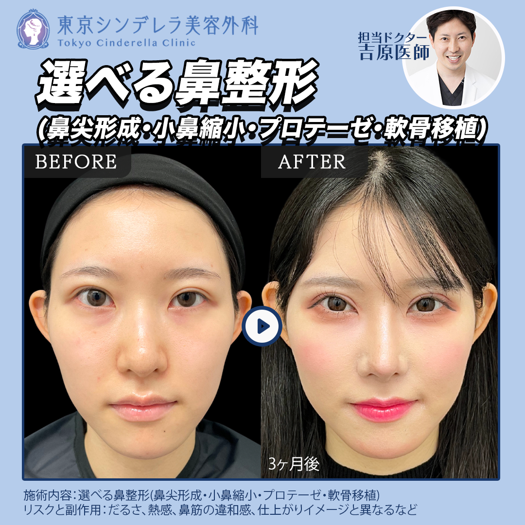 鼻形成術後の自分の鼻が嫌い… : r/PlasticSurgery, image size:1080x1080