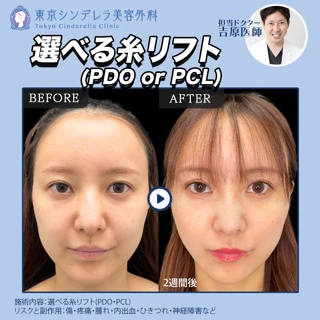 選べる糸リフト｜PDO8本 or PCL6本｜《追加料金なし》 ｜再来OK
