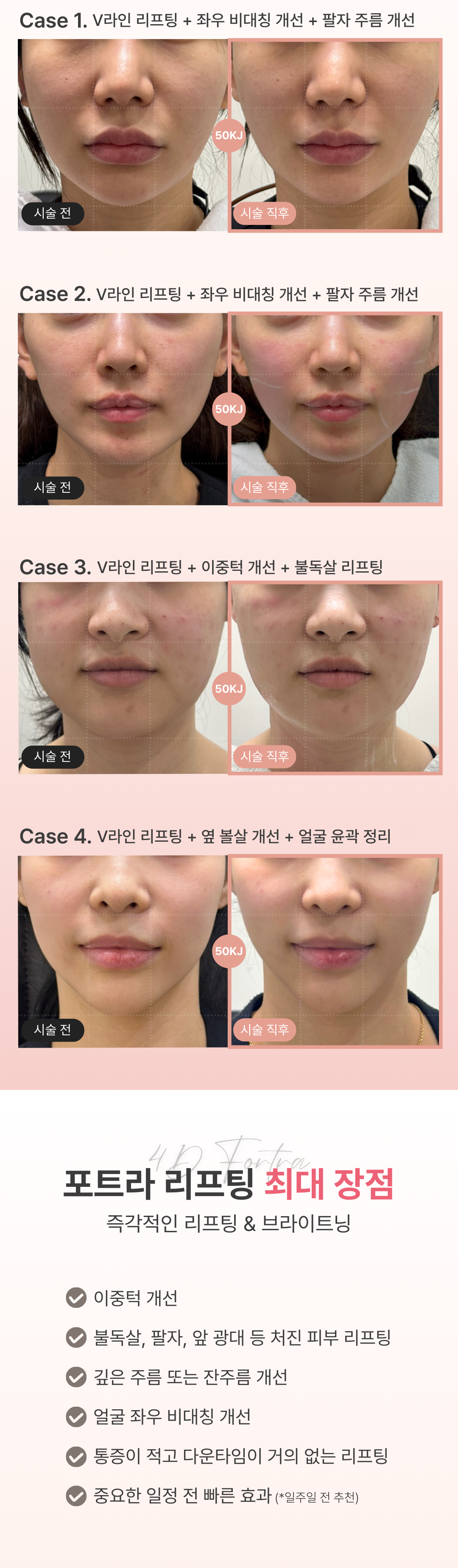 세계 최초
4가지 파장의 포트라 리프팅
포트라 리프팅?
포트라는 일정한 면적형태의 레이저 빔이 유지인대 부위에 열적 자극을 주어 새로운 콜라겐 생성을 유도하고 유지인대 조직이 다시 재생될 수 있도록 효과적으로 자극합니다.
유지인대?
얼굴의 생명나무라 불리며, 뼈의 골막부터 진피까지 피부탄력을 유지하도록 잡아주는 젊음 유지의 필수 조직입니다.
시술효과
1. 콜라겐 재생을 통한 리모델링
2. 즉각적인 리프팅 효과
3. 즉각적인 브라이트닝
4. 즉각적인 지방 수축
5. 피부 개선
6. 탄력 강화
효과 원리
1. 피부층별 에너지 매칭
- 755, 808, 940, 1064nm 피부층별로 에너지를 한 번에 전달
2. 에너지 전달 깊이 최대 10mm
- 유지인대 작용에 필요한 깊이까지 에너지 전달
3. 개인 피부 에너지값 맞춤 시술
- 에너지 강도와 전달 방식을 선택하여 개인 맞춤형 시술 가능
4. 시간당 토탈 에너지 증가
- 최적의 에너지를 빠르게 높여 리프팅 효과 극대화
5. 쿨링 시스템을 통해 피부 손상 없이 안전하게
오직 Project U 에서만?
Custom Lifting System으로 1:1 맞춤 시술이 진행됩니다
1. 3D 정밀 진단 - 피부 상세 분석
2. 고객 니즈 - 부위별 매칭값 점검
3. 의료진 1:1 맞춤 디자인 및 시술