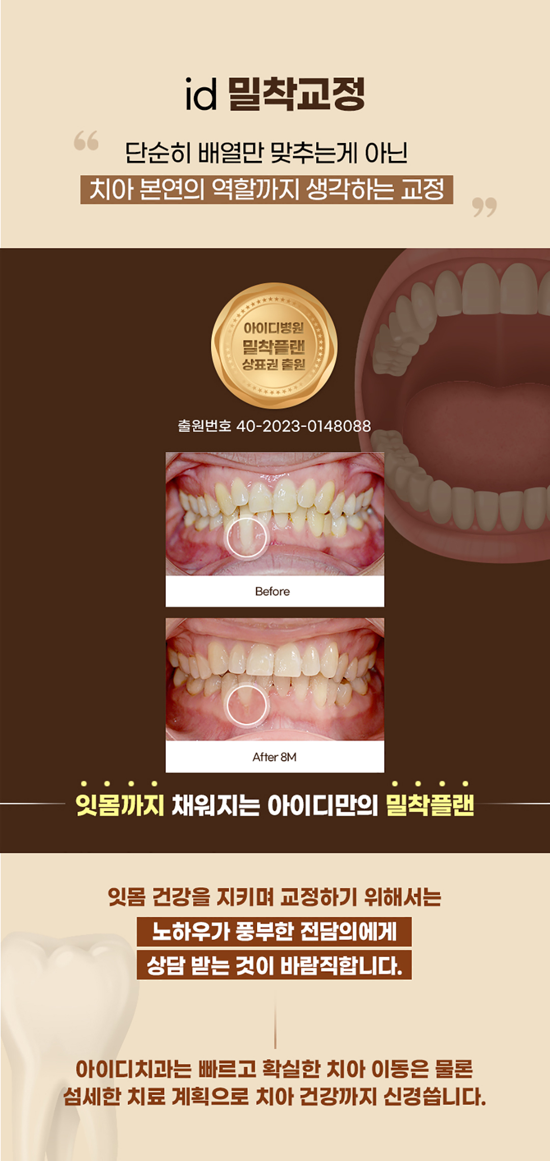 치아교정, 분납으로 비용부담 적게
부분교정으로 원하는 곳만 빠르게
