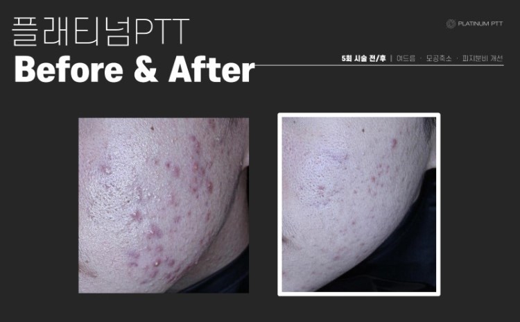 플래티넘 골드 PTT는 금과 백금 나노입자를 피부에 도포한 후, 특정 파장의 레이저를 조사하여 나노입자에 의해 열이 발생하도록 합니다. 이 열은 피지선에 직접 작용하여 과도한 피지 분비를 억제하고, 여드름 균을 파괴합니다. 이 치료법은 피지선에만 선택적으로 열 손상을 주기 때문에 주변 피부 조직에는 최소한의 손상을 주며, 이는 치료 후 회복 시간을 단축시키는 데 기여합니다.
피지선 축소를 통한 여드름 개선과 피부 재생, 콜라겐 층 치밀도 증가를 통한 탄력 개선에도 효과적입니다.