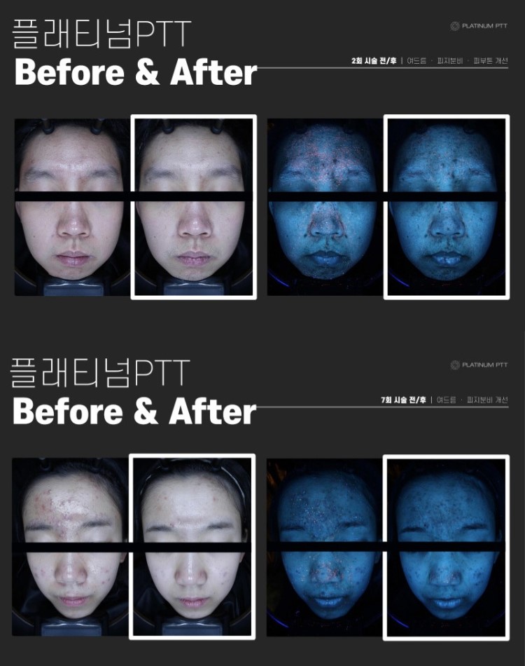 플래티넘 골드 PTT는 금과 백금 나노입자를 피부에 도포한 후, 특정 파장의 레이저를 조사하여 나노입자에 의해 열이 발생하도록 합니다. 이 열은 피지선에 직접 작용하여 과도한 피지 분비를 억제하고, 여드름 균을 파괴합니다. 이 치료법은 피지선에만 선택적으로 열 손상을 주기 때문에 주변 피부 조직에는 최소한의 손상을 주며, 이는 치료 후 회복 시간을 단축시키는 데 기여합니다.
피지선 축소를 통한 여드름 개선과 피부 재생, 콜라겐 층 치밀도 증가를 통한 탄력 개선에도 효과적입니다.