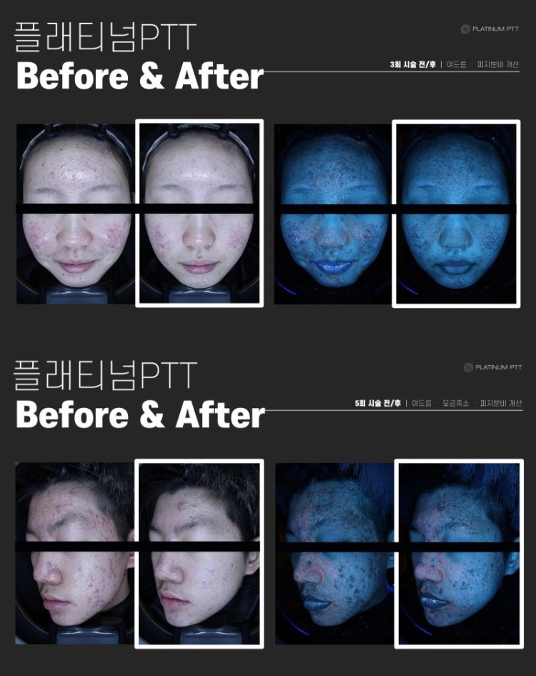플래티넘 골드 PTT는 금과 백금 나노입자를 피부에 도포한 후, 특정 파장의 레이저를 조사하여 나노입자에 의해 열이 발생하도록 합니다. 이 열은 피지선에 직접 작용하여 과도한 피지 분비를 억제하고, 여드름 균을 파괴합니다. 이 치료법은 피지선에만 선택적으로 열 손상을 주기 때문에 주변 피부 조직에는 최소한의 손상을 주며, 이는 치료 후 회복 시간을 단축시키는 데 기여합니다.
피지선 축소를 통한 여드름 개선과 피부 재생, 콜라겐 층 치밀도 증가를 통한 탄력 개선에도 효과적입니다.