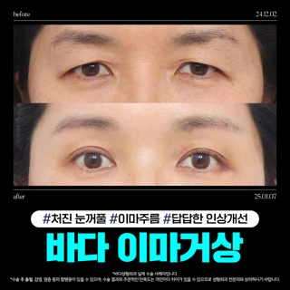 처진 이마, 눈썹, 눈꺼풀 고민_내시경 이마거상