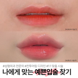 입술 입꼬리 전체 필러