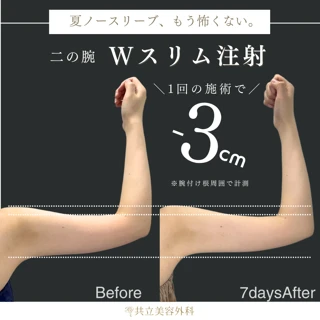 【脂肪を破砕&溶解!新しい痩身治療】共立オリジナル:Wスリム注射