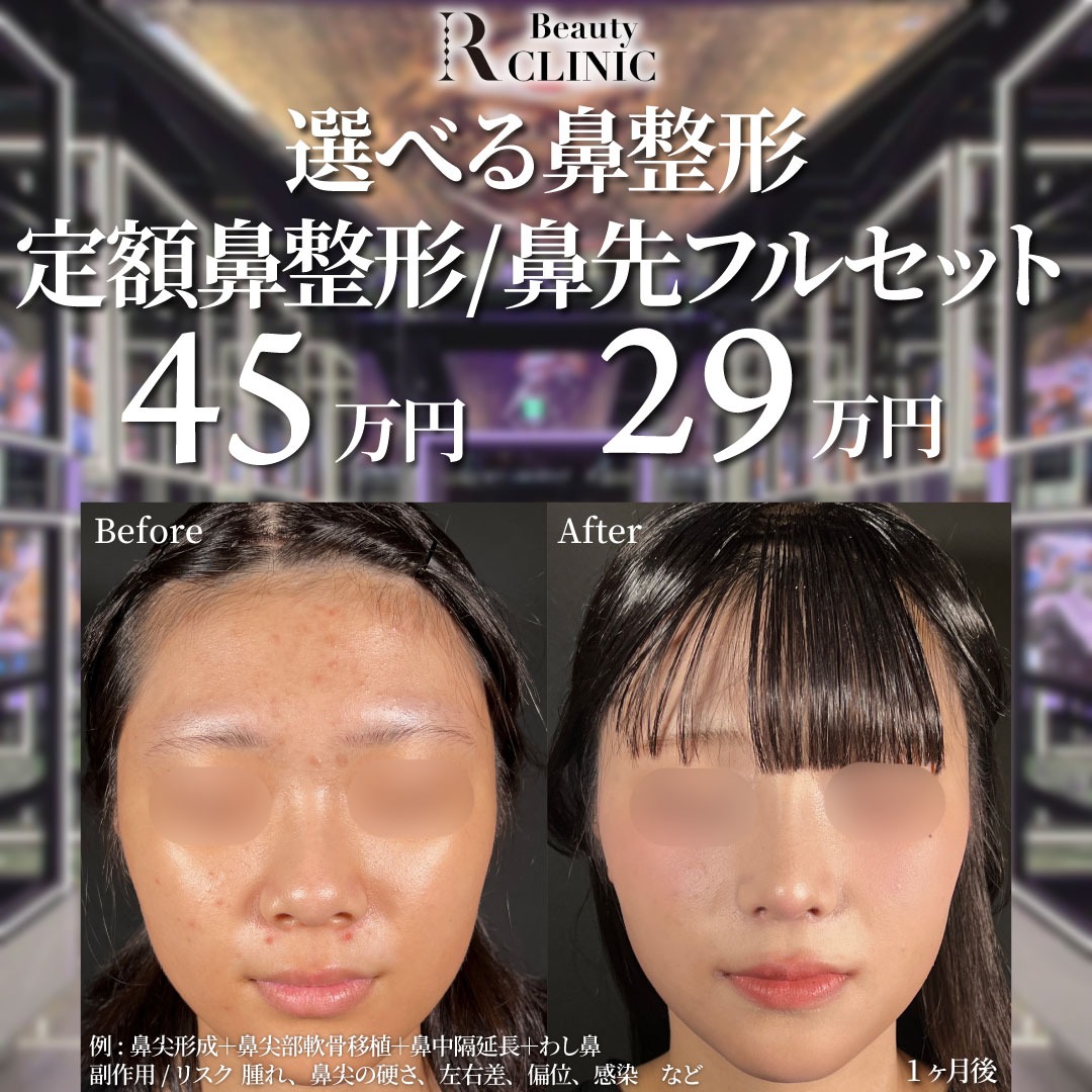 くちばし鼻整形の施術・口コミ・クリニック情報(2025