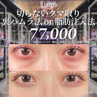 【外科専門医が執刀（名古屋・銀座院）】脱脂術 or 裏ハムラ法 or 脂肪注入法｜あなたに合わせた施術法を