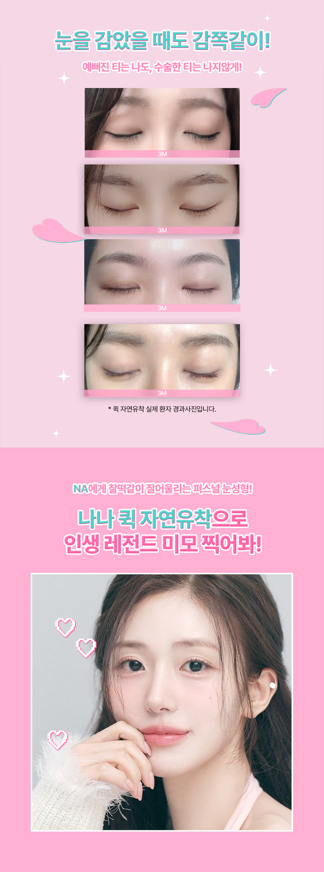 두번 묶어 풀릴 걱정없는 눈성형, 눈을 감아도 티 안나는 예쁜 세미아웃 라인