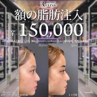 額の脂肪注入 自身の脂肪で定着率UP｜キレイで丸いおでこで垢抜け