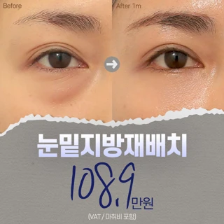 다크써클out,눈밑지방재배치
